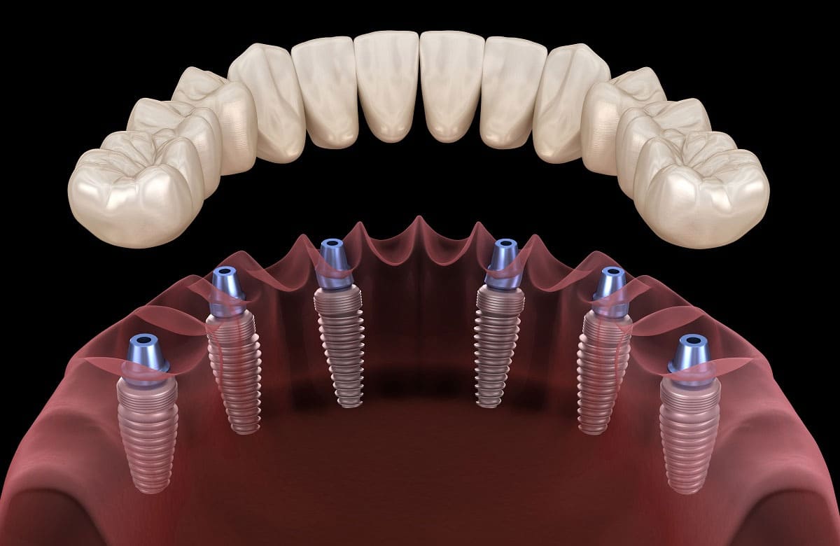 Full Mouth Dental Implants: A Complete Guide