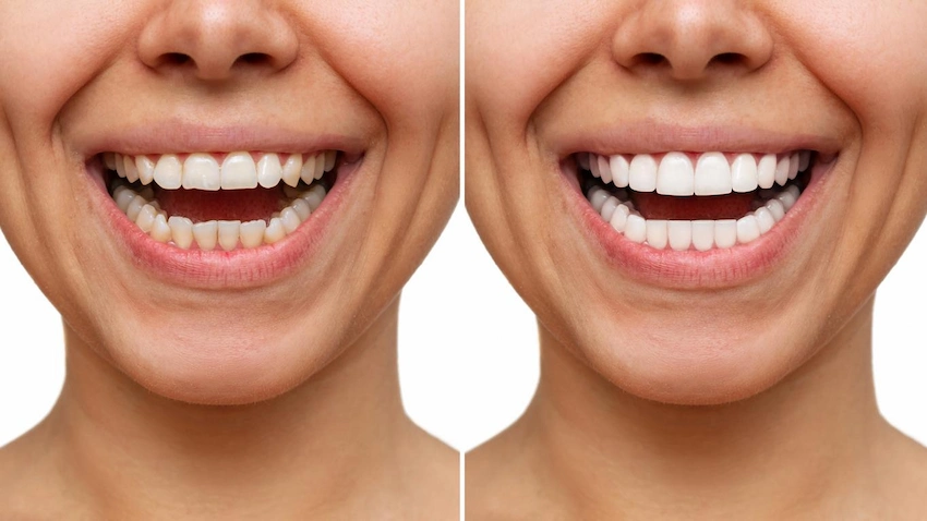 crowns veneers understanding the difference