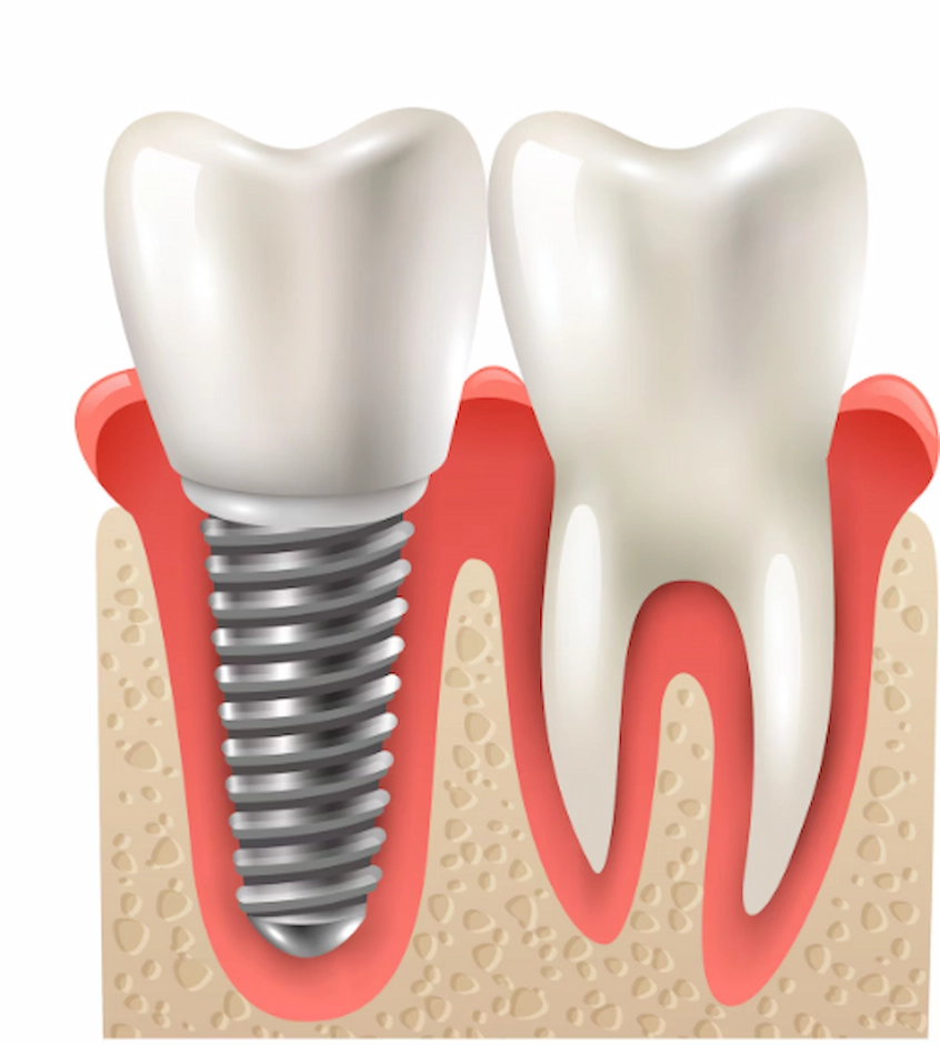 дental implant