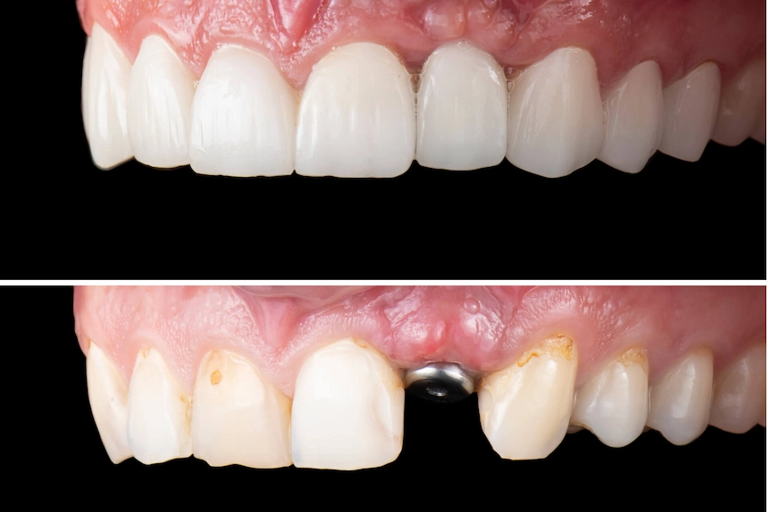 dental implants vs veneers