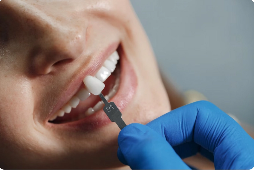 emax dental veneers