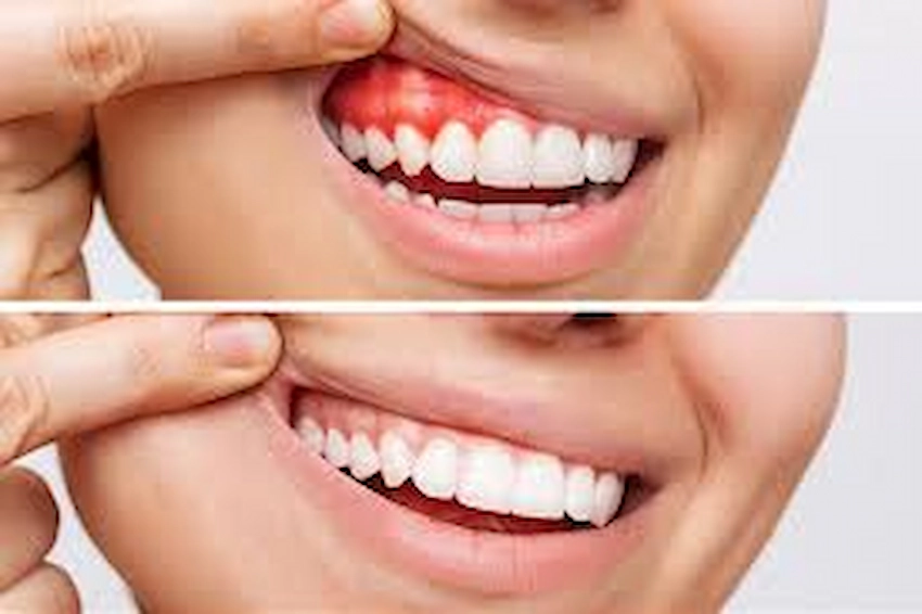 gum disease treatment