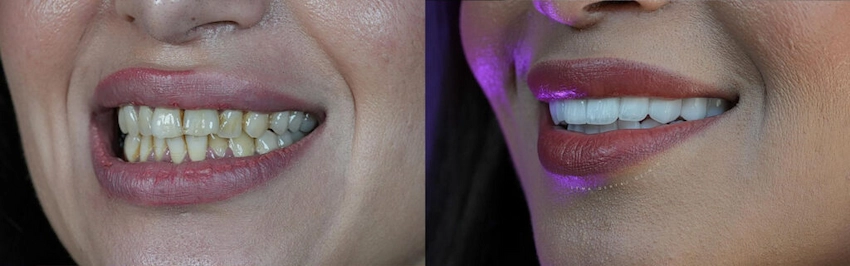 how long will my veneers last