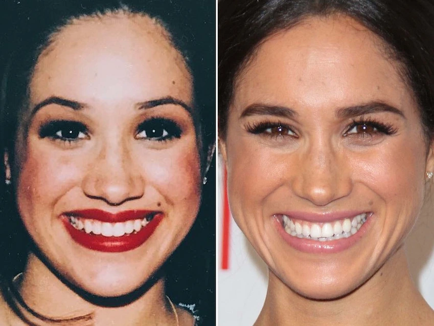 meghan markle before and after kapak