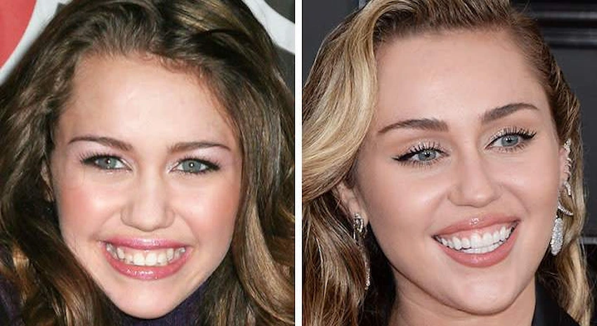 miley cyrus teeth before after