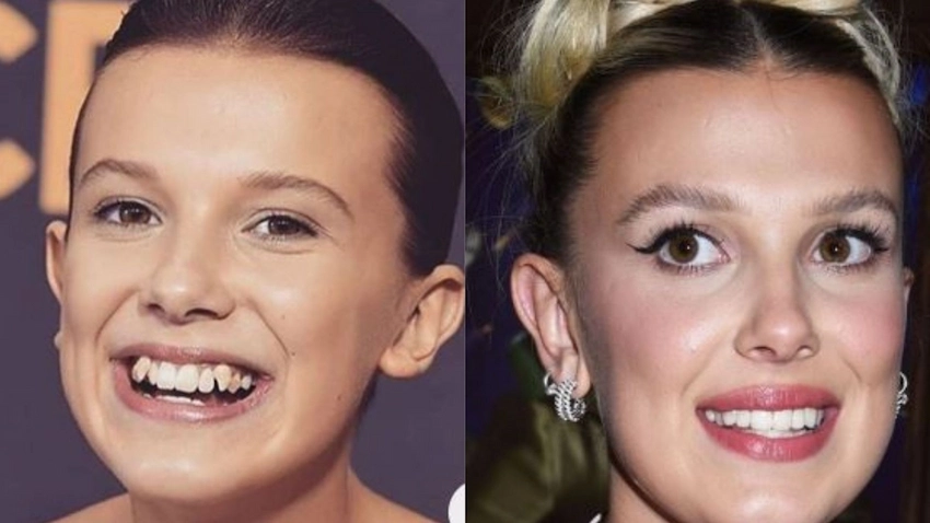 millie bobby brown before after