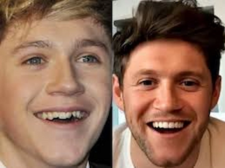 niall horan teeth before after