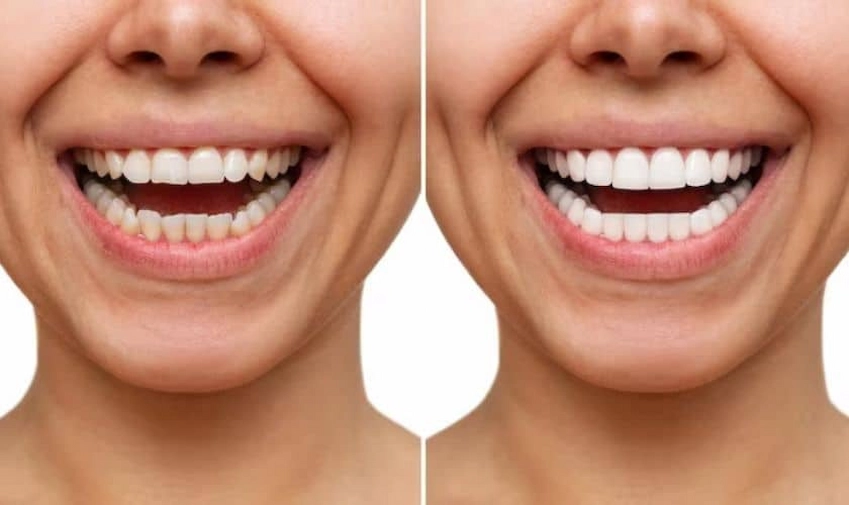 perfect smile tips and tricks