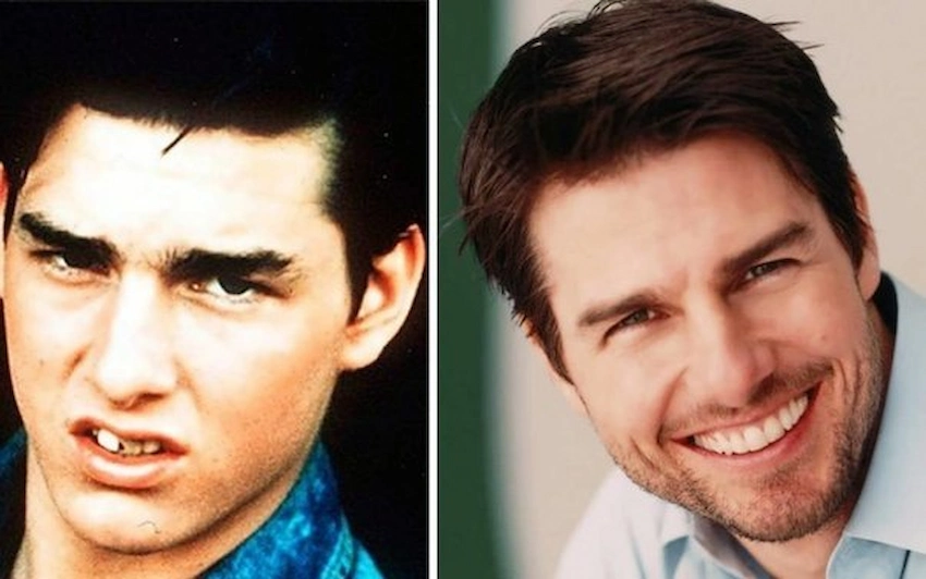 tom cruise teeth before and after teeth