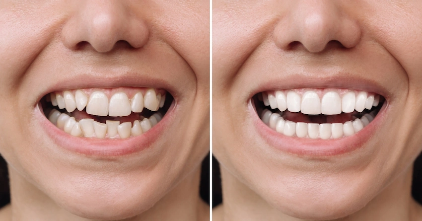 zirconium crown before after