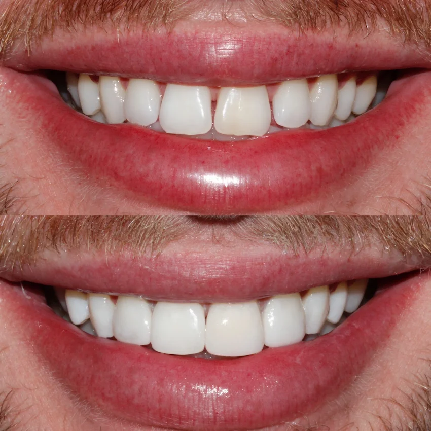 composite bonding before after