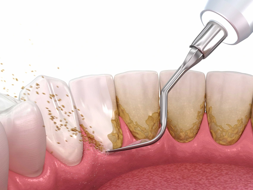 dental tartar