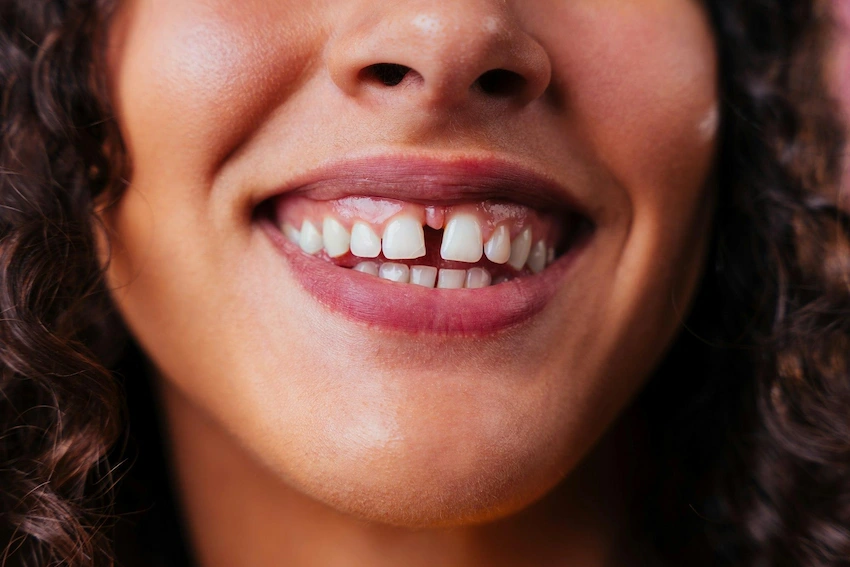 diastema causes and treatments