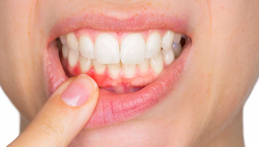 gum grafting procedure