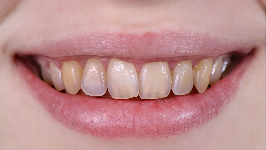 what is dental tartar
