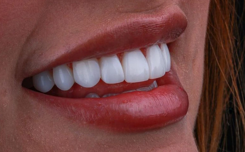 zirconia