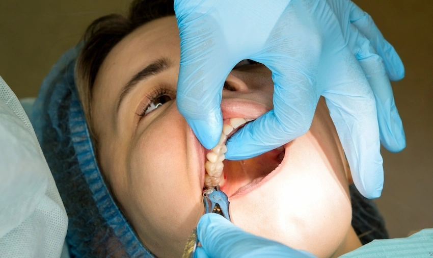 how to speed up wisdom teeth recovery