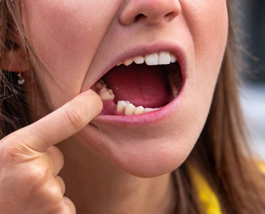 why no dairy after tooth extraction