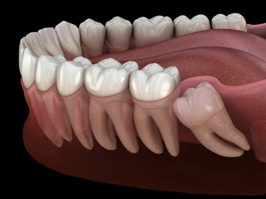 wisdom teeth 1