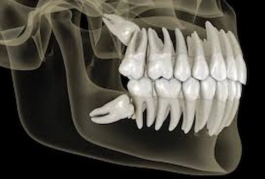 wisdom teeth