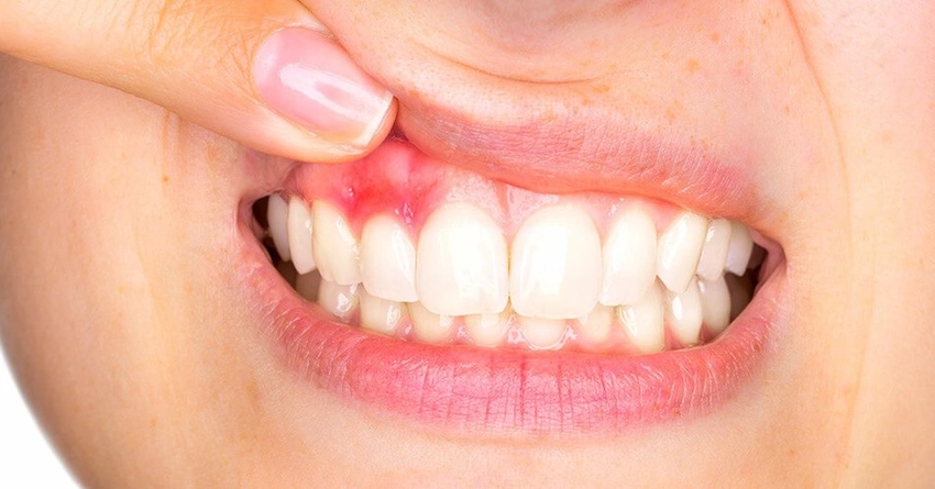 How to treat inflamed gums effectively