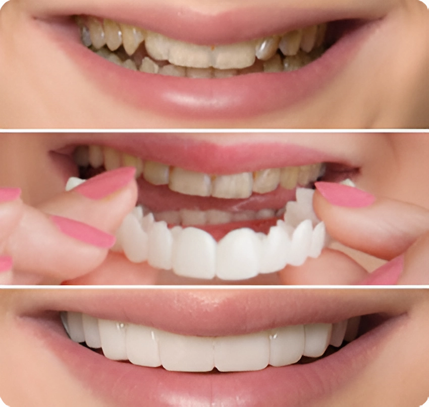 before after veneers