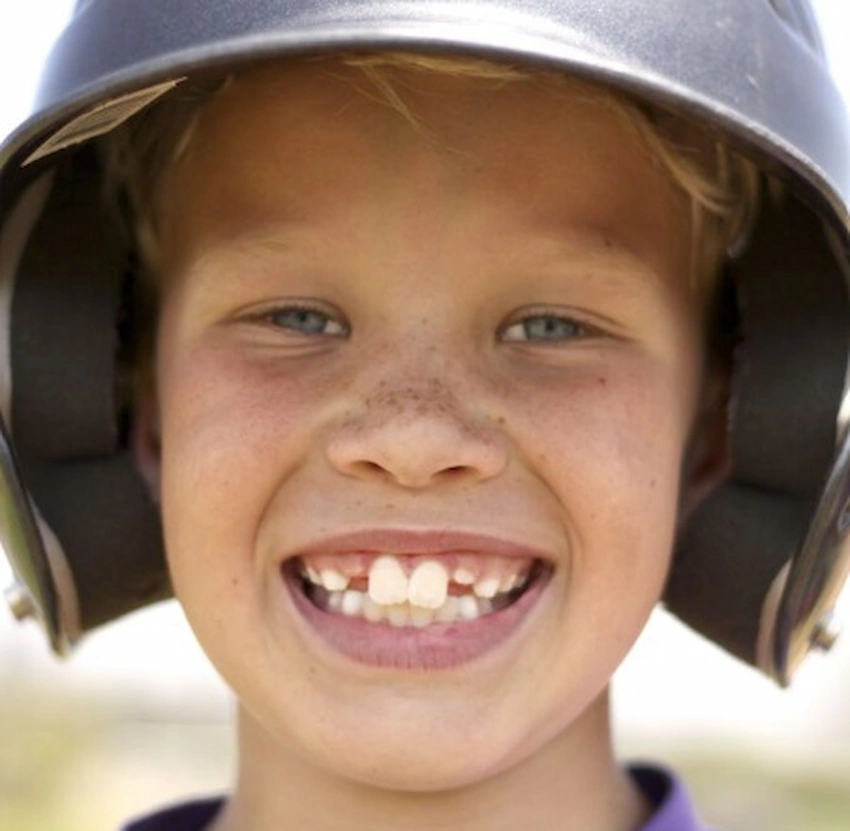 buck teeth