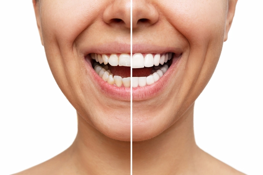 clip on veneers are they worth it