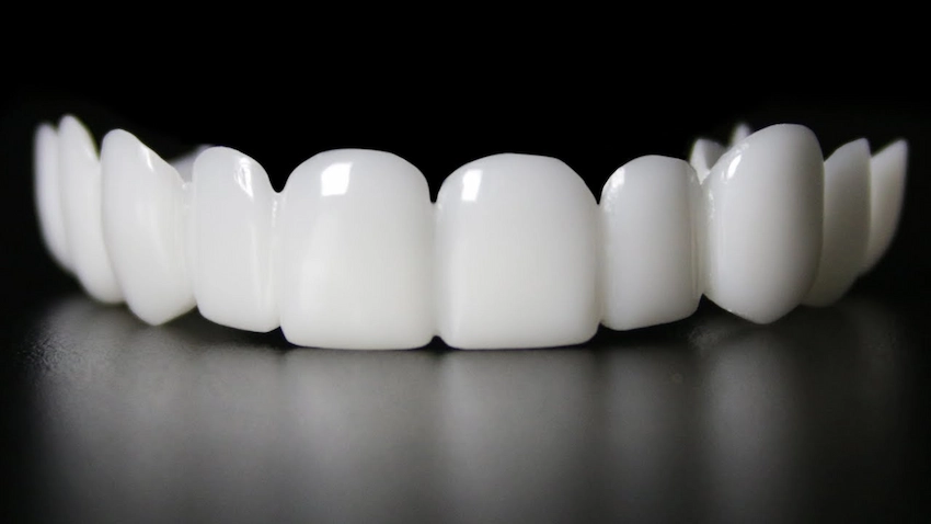 clip on veneers