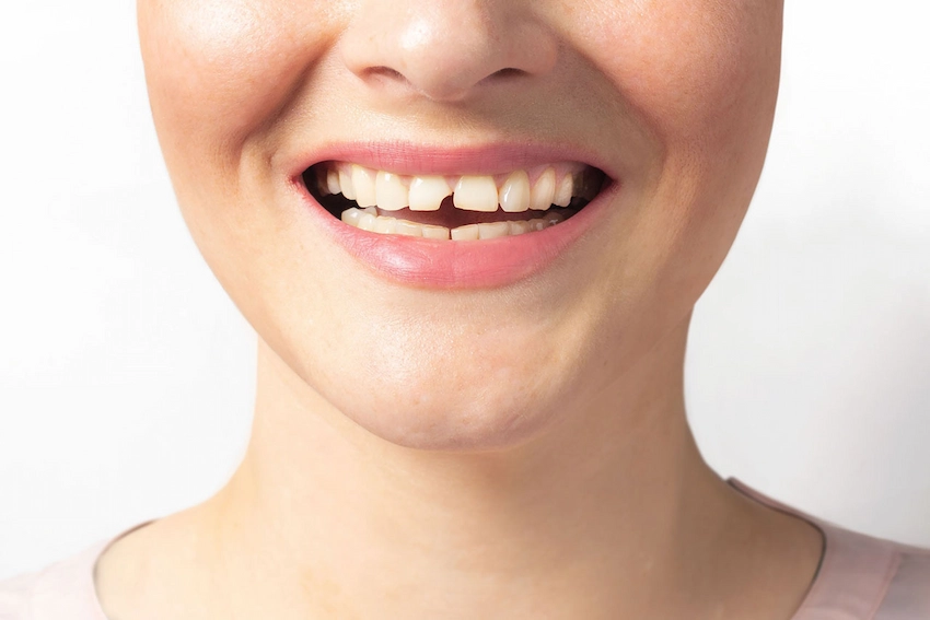 diy solutions for hiding a broken tooth