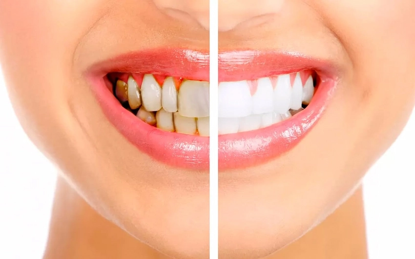 effective tartar removal techniques