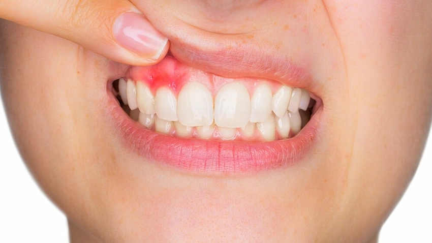 effective treatment for receding gums