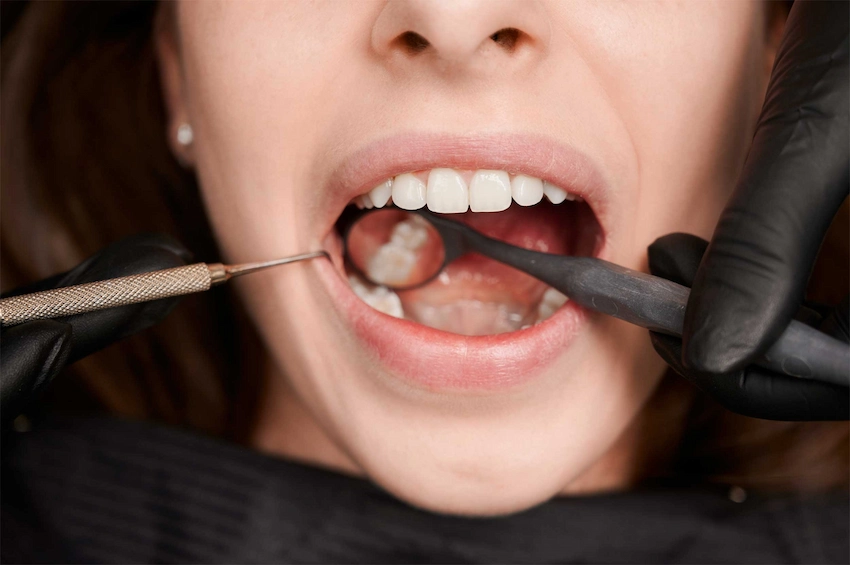 foods to eat after wisdom teeth removal
