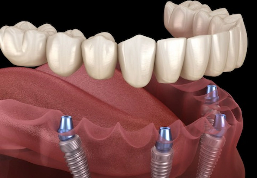full implant