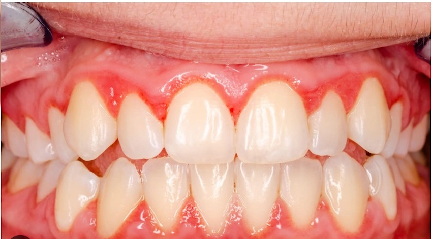 gum issue