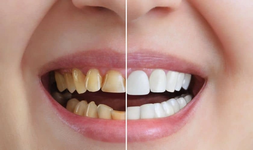 home remedies for yellow teeth