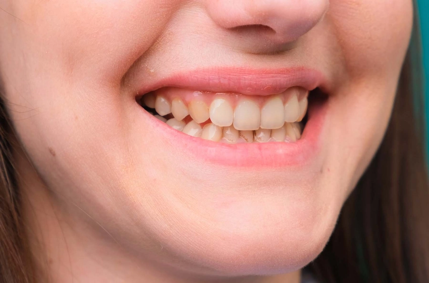 how to get rid of yellow teeth permanently