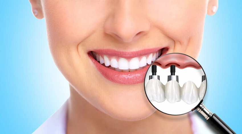 mouth implant