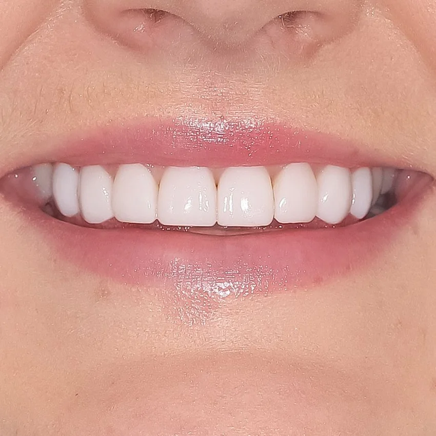 veneers