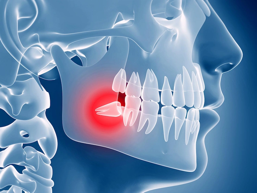 what should you eat after wisdom tooth extraction