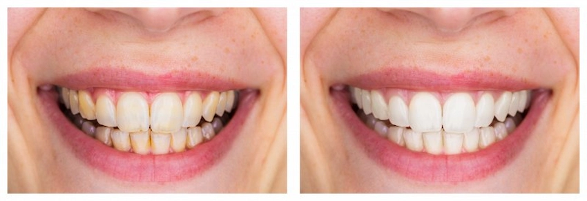 dientes amarillos antes y después