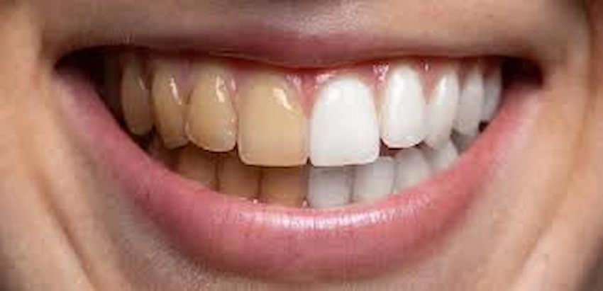 dientes amarillos