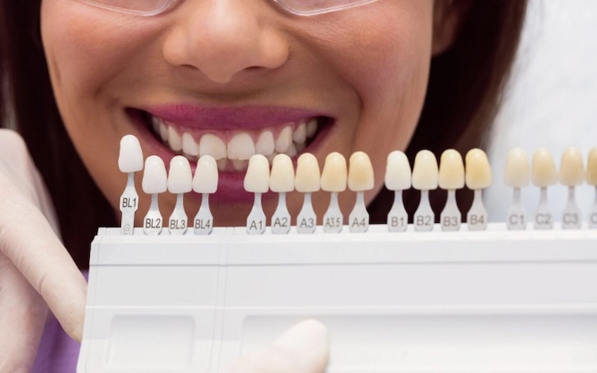 dental veneers treatment