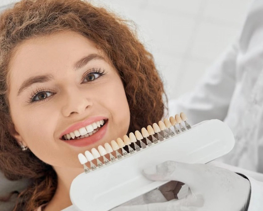 dental veneers