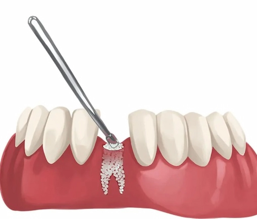 bone grafting procedure