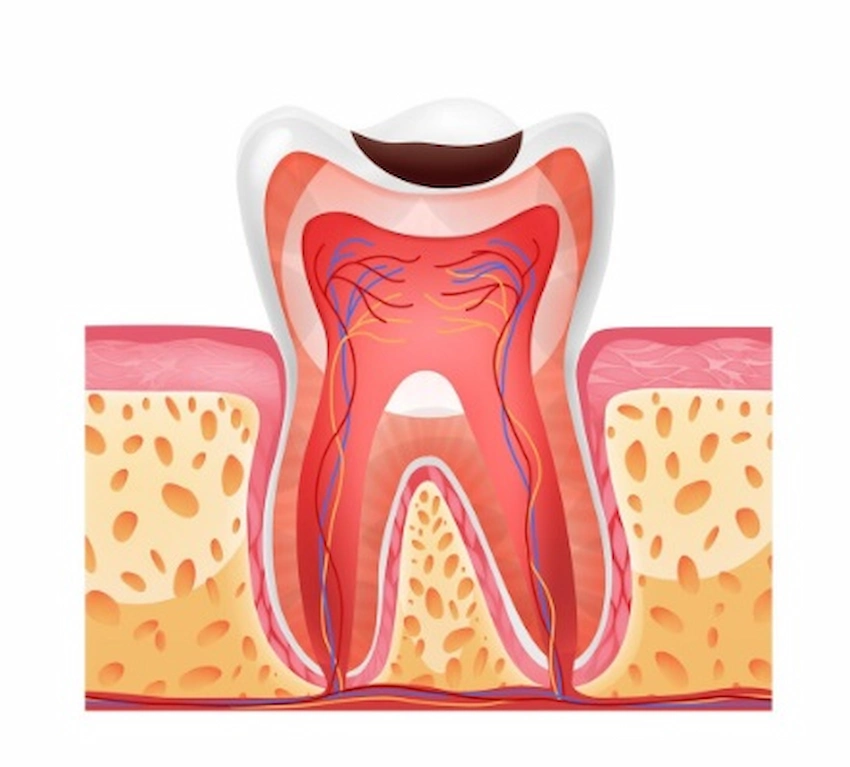 cavities