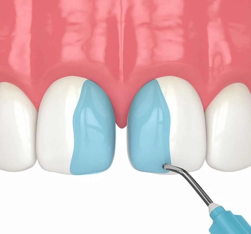 dental bonding