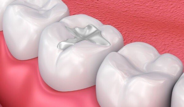 dental filling treatment