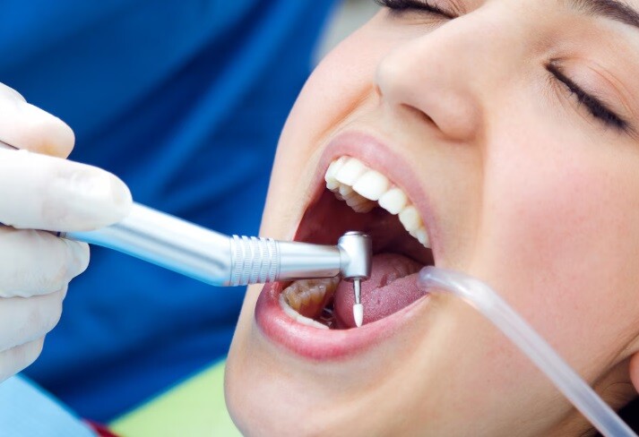 dental filling