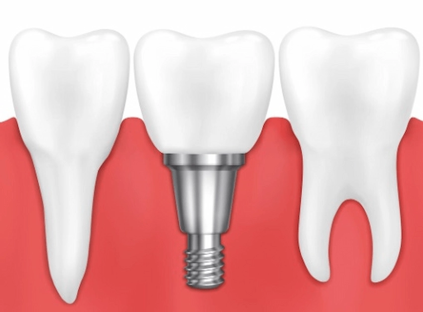 dental implant after